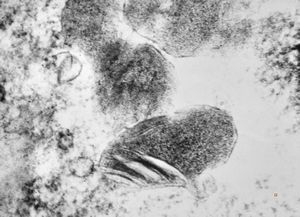 F,12y. | oligodendroglioma F,12y. | oligodendroglioma